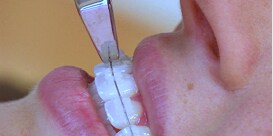Vrouw bij wie brackets worden gedebondeerd
