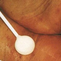 IAD incontinentiedermatitis