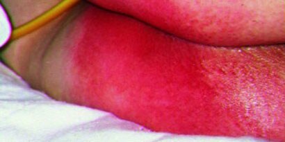 Incontinentie dermatitis
