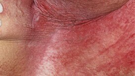 Intertrigineuze dermatitis
