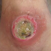 verband