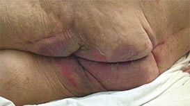 Incontinentie Dermatitis
