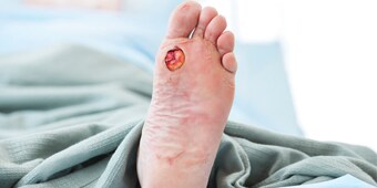 Diabetische voetulcera
